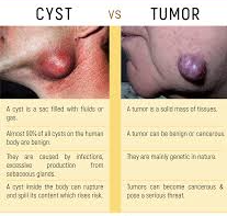 Difference between cyst and tumor